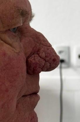 Homem idoso em perfil com aumento importante do nariz, pele espessada e lobulada, aspecto compatível com rinofima avançado.