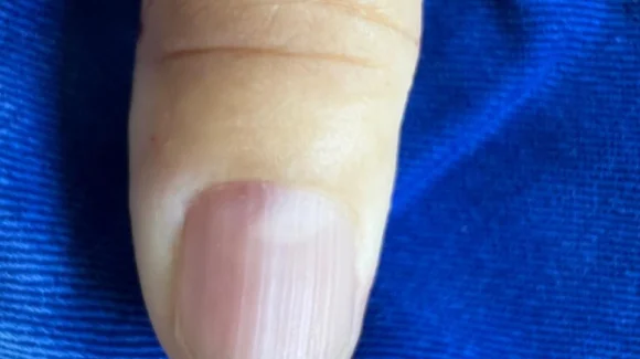 Tumor glômico: dor forte em um ponto da unha Tumor glômico: dor forte em um ponto da unha