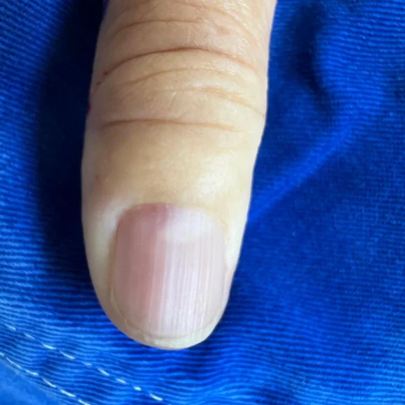 Tumor glômico: dor forte em um ponto da unha