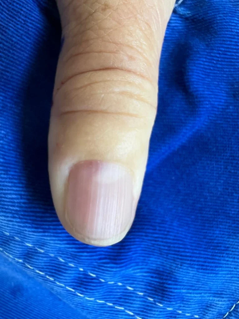 Unha da mão com discreta alteração rosada longitudinal, imagem usada para ilustrar suspeita de tumor glômico subungueal.