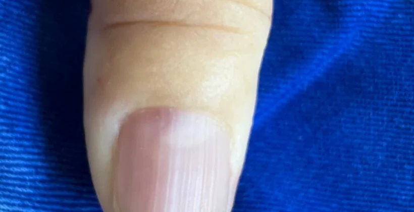 Tumor glômico: dor forte em um ponto da unha