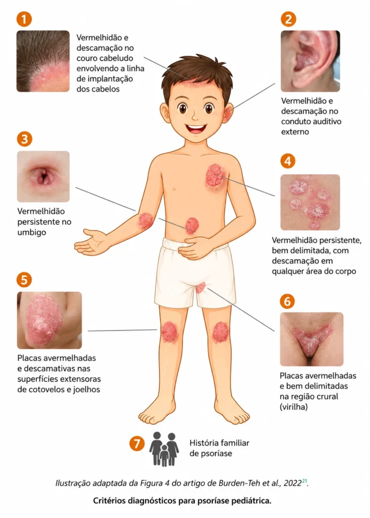 Ilustração adaptada dos critérios diagnósticos da psoríase em crianças, mostrando lesões no couro cabeludo, ouvido, umbigo, cotovelos, joelhos e virilha.