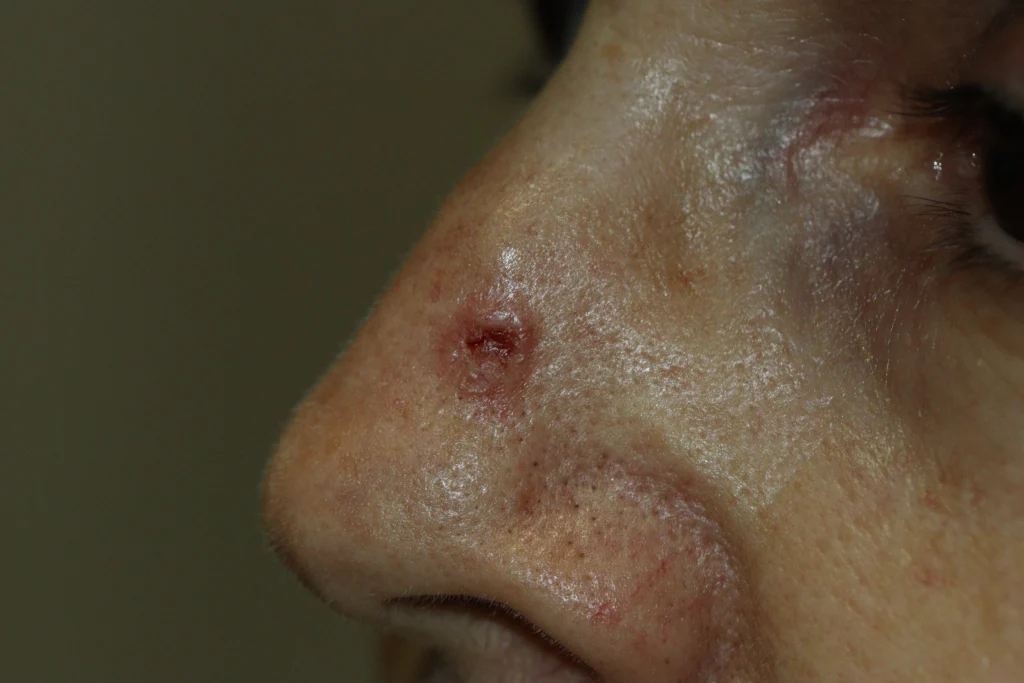 Carcinoma basocelular no nariz com pequena lesão ulcerada e crosta