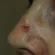 Carcinoma basocelular no nariz: como identificar, diagnosticar e tratar?
