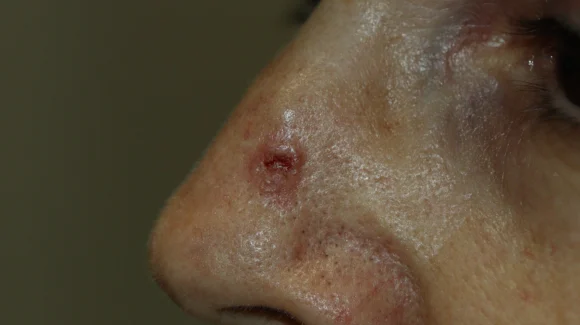 Carcinoma basocelular no nariz: como identificar, diagnosticar e tratar?