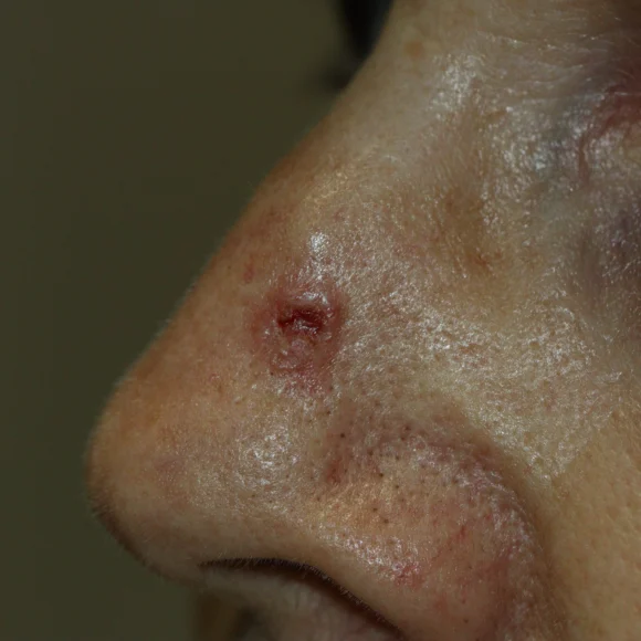 Carcinoma basocelular no nariz: como identificar, diagnosticar e tratar?