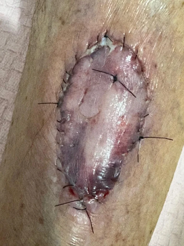 Enxerto de pele na perna com 10 dias de cicatrização após cirurgia