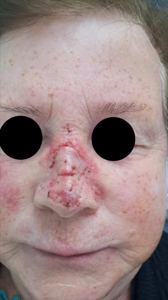 Enxerto de pele de espessura total no dorso nasal com 10 dias de cicatrização