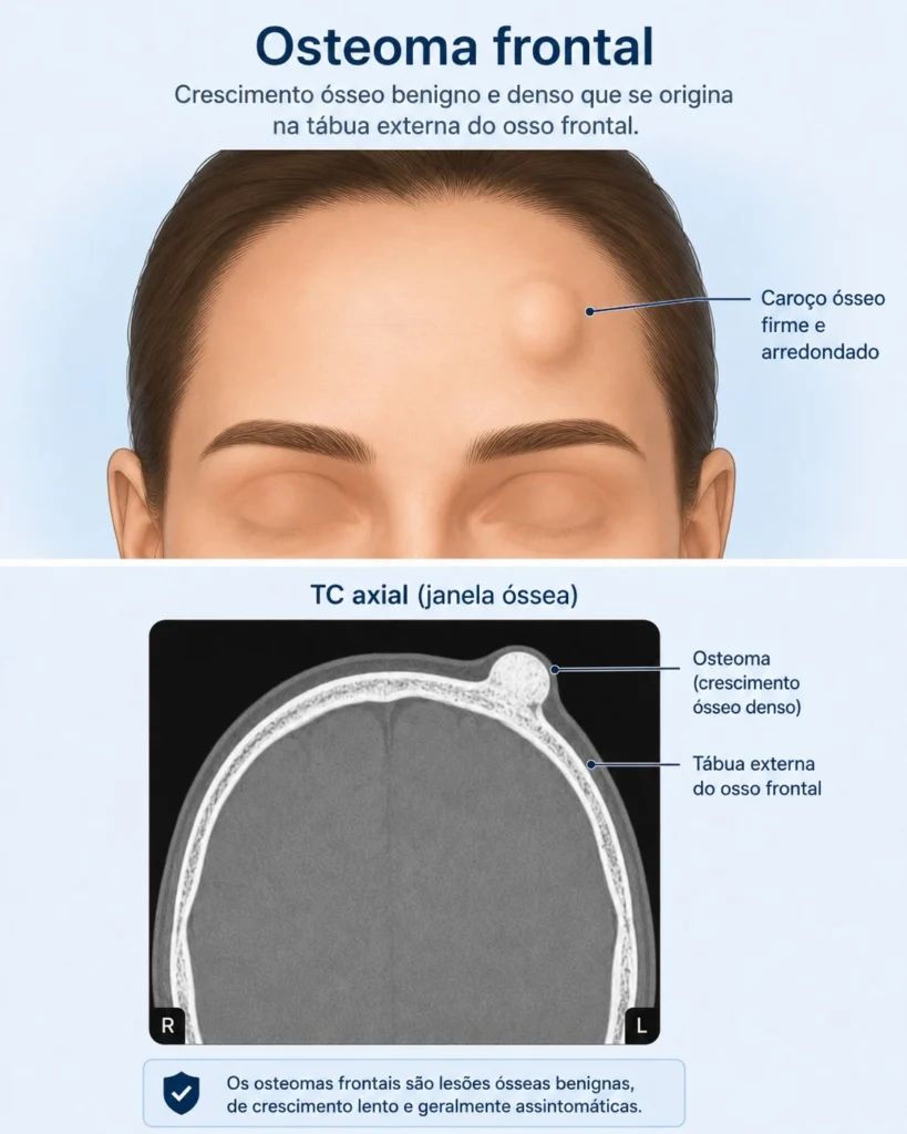 Ilustração de osteoma frontal com caroço duro na testa e tomografia esquemática