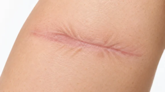 Correção de cicatriz após cirurgia: é possível melhorar?