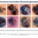 Carcinoma basocelular em pele negra: como esse câncer de pele pode aparecer?